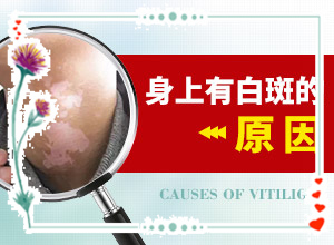 白巔峰的早期特征,如何知道白斑是否為白癜風(怎么診斷鑒別)