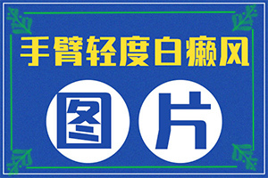 黑色素移植費用怎么算-[真實案例]治療干貨在這里