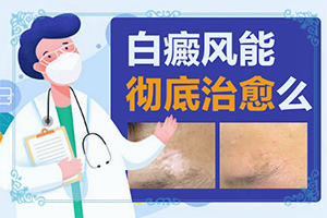 白癩風(fēng)有哪些的癥狀,患上了會(huì)出現(xiàn)哪些癥狀(好發(fā)部位有哪些)