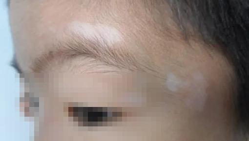 小孩身上有白斑怎么辦？