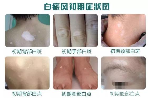白癜風(fēng)早期