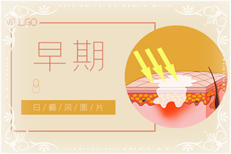 白點(diǎn)風(fēng)病情發(fā)作后白斑癥狀，你了解了嗎