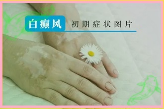 白白課堂|孕婦白點癲風是什么原因引起的-科學檢測便利病情醫(yī)治