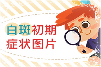 白點(diǎn)風(fēng)能嗎-病情反復(fù)發(fā)作-科學(xué)醫(yī)治才是正途