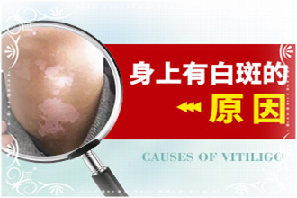 {青少年}白癲風(fēng)初期癥狀病發(fā)因素有什么