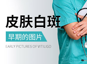 【】魯索替尼治療白癜風使用有哪些