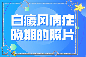 小孩入秋臉上長白斑是怎么回事,得白癜風(fēng)的概率(何種原因呢)