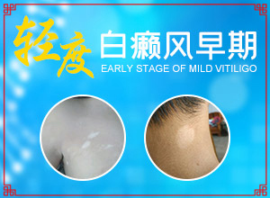 臉上長的白斑怎么回事-誘發(fā)的原因有