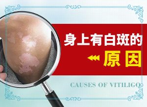 白癲瘋出起癥狀的圖片,怎么能看出長(zhǎng)啥樣的(征兆有哪些)