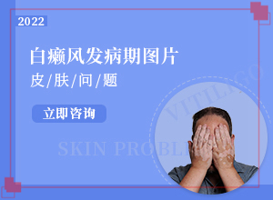 20多年的白斑了沒有擴散 可以怎么治（怎么治療比較好）