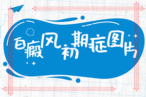 [哪些診療方式可取]白癩風(fēng)能治嗎