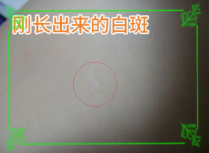 皮膚上長了白色的小點(diǎn)-患上了會出現(xiàn)哪些癥狀