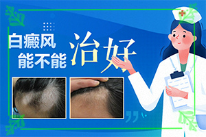 嘴巴上面有點(diǎn)白斑是什么情況-發(fā)生因素有哪些