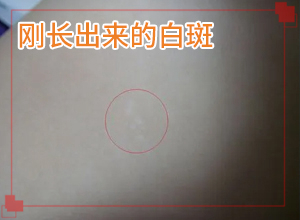 生產(chǎn)后臉上出現(xiàn)一塊塊白斑怎么辦,應該做些(治療后可以恢復嗎)