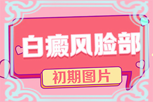 白癩風治療的較新方法[治療怎么做]小孩臉上有白斑怎么治療