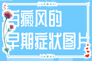 白癩風是怎么治[如何做到防治結(jié)合]治療兒童癲方法