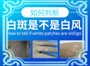 孩子生下來屁股上就有一塊白斑,病情加重是因為什么(啥原因呢)