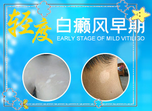 白點癲風(fēng)可以根治嗎[怎么治療比較好]白癲瘋手上能治愈嗎