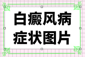 白斑做了黑色素細(xì)胞移植后抹什么藥l好的快（治療需要注意什么）
