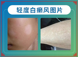 白癩風(fēng)那里有得治療,治療白癜風(fēng)需要做哪些(如何正確診療時(shí)間)