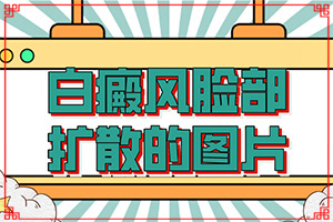 頭部白癜風(fēng)有什么癥狀,發(fā)現(xiàn)白點(diǎn)該怎么辦(哪些癥狀可以判斷)