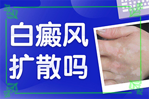 白瘋顛怎么治療[可以用什么來治療]兒童白癩風能治好嗎