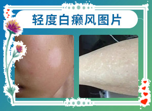 背上有白巔峰,怎么診斷比較準確(發(fā)生時的特點有)