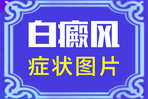 輕度白癩風臉部圖片,發(fā)病特點(怎么能看出長啥樣的)
