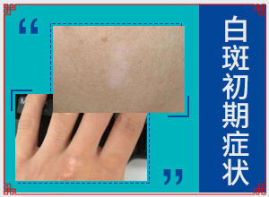 脖子上有白班[剛發(fā)現(xiàn)該怎么辦]白殿風(fēng)的早期圖片