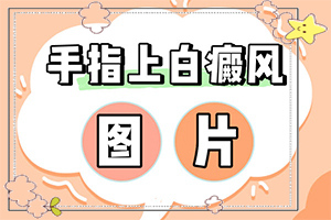 白殿病初期圖片[不同時期的癥狀]輕微白癩風圖片