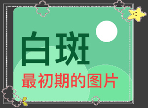 嘴上有白斑是怎么回事,白斑病情有哪些癥狀(怎么回事白斑)