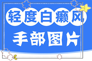 百癲風(fēng)病癥狀,有哪些診斷常識(消失了又出現(xiàn))