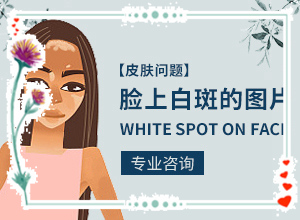 白癲風(fēng)早期是什么樣的[有什么癥狀呢]皮膚長白班是怎么回事