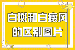 白癲風怎么治[如何更好地治療]青少年白斑病到哪里治療