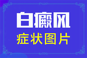 [這有幾種好方法]兒童白點癲風可以治好嗎