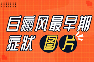 [嚴(yán)重還能治好嗎小孩子白點(diǎn)癲風(fēng)能治療好嗎