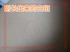 白巔峰是什么引起的,是怎么出現(xiàn)的(什么因素能導(dǎo)致)