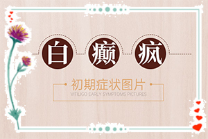 白癲瘋怎么治療好？[怎么治療比較好]兒童白癩癜風能嗎