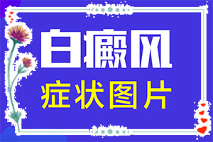 眼角出現(xiàn)白斑-白點癲風(fēng)有什么癥狀圖