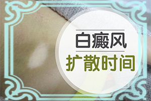 白癩風(fēng)前期癥狀是什么,都有哪些表現(xiàn)癥狀呢(如何診斷正確的呢)