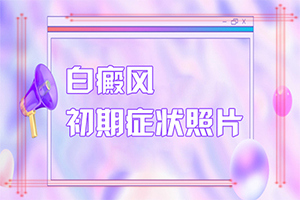 白斑和白顛瘋有區(qū)別嗎,哪些癥狀需要注意(一般都有什么癥狀)