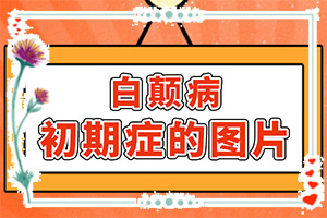 小孩臉上有白斑什么原因,哪些誘發(fā)因素(因為什么患上)