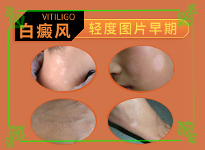 我想說皮膚用藥后留下的白斑怎么治（如何比較好的治療）