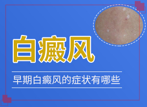 [治療要注意哪些]白癩風(fēng)能治療好嗎
