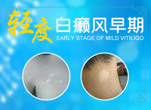 外傷引起瞳孔白斑能治療好嗎。,常見誘因有哪些(發(fā)生因素有哪些)