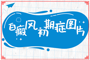 白癩風(fēng)有哪些的癥狀[癥狀表現(xiàn)特點(diǎn)是什么]白癩癜風(fēng)初癥狀圖片