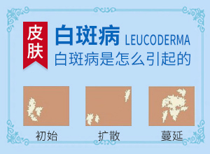 [多年白癜風怎么治]白癲瘋手上能治療好嗎