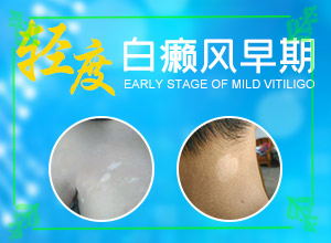 白巔峰的治療方法-[推薦閱讀]白斑治療進展分析