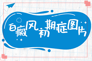 [如何正確診療時(shí)間]白癲瘋能治療嗎