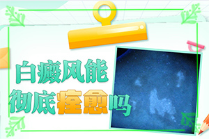 白癲風(fēng)初期癥狀圖片[怎么能看出長(zhǎng)啥樣的]輕度白癩風(fēng)圖片早期